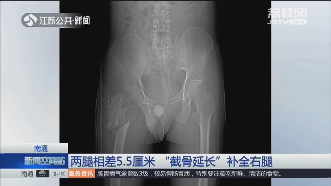 先髋截骨手术后腿会变长还是变短,右腿比左腿短2公分怎么办