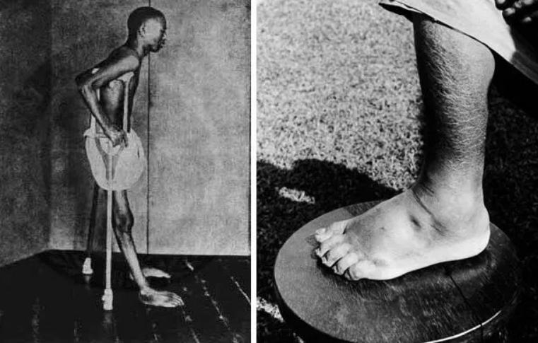 各类脚气病的治疗方法,困扰了几年的脚气