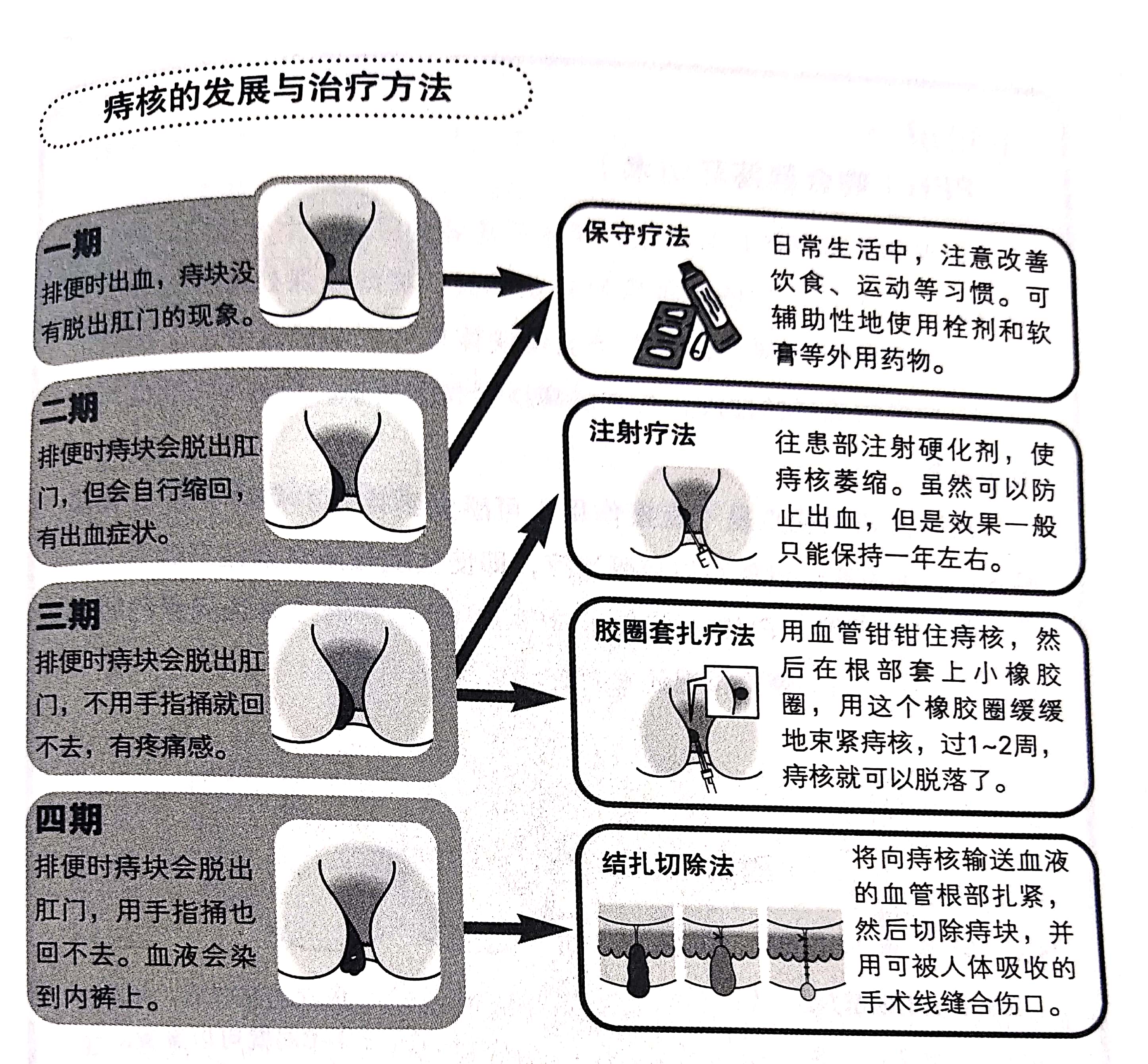 痔疮会自愈吗,什么药治痔疮