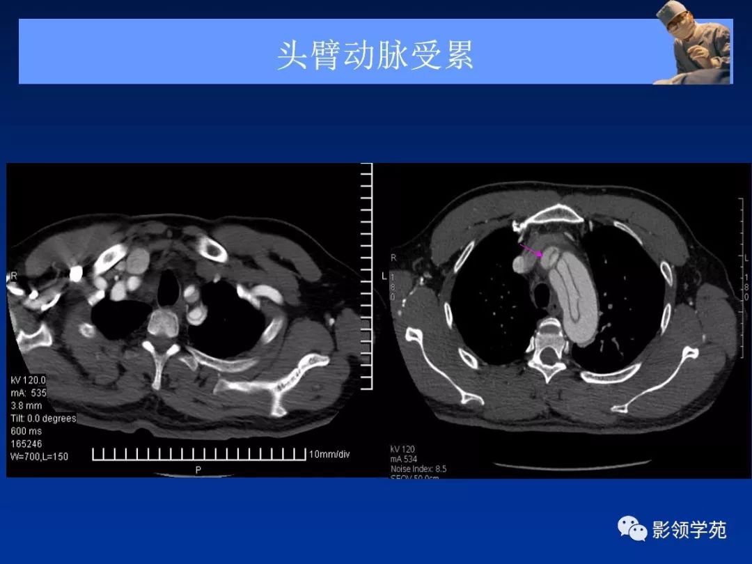 主动脉夹层壁间血肿如何鉴别,主动脉夹层血肿溃疡