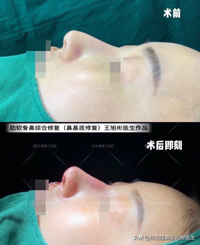 大鼻头能做直鼻微翘吗,可以只做鼻头缩小术吗