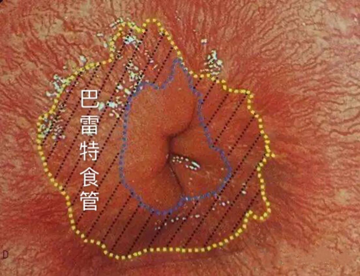 巴雷特食管的发病原因,巴雷特食管咳嗽吃什么药好得快