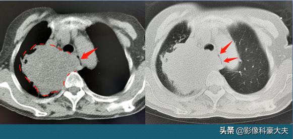 三种情况发现是肺癌晚期,晚期肺癌不咳嗽爱睡觉是怎么回事