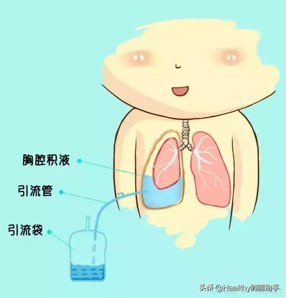 肺癌喘不过气来吃什么中药能缓解,肺癌喘不上气来怎么缓解