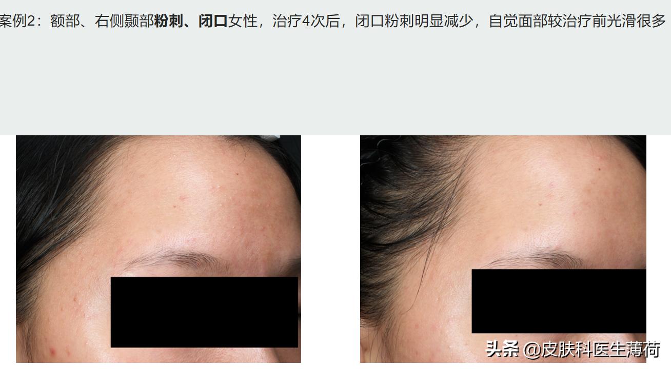 修复痘坑水杨酸果酸哪种好用,刷酸去闭口水杨酸敏感肌