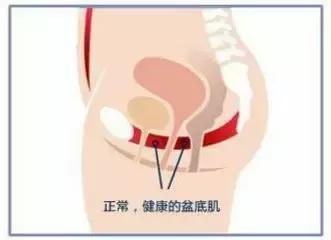 笑得尿失禁怎么办,笑会流尿出来是什么原因