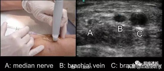 超声引导下血管穿刺效果评价,超声引导下血管穿刺置管流程