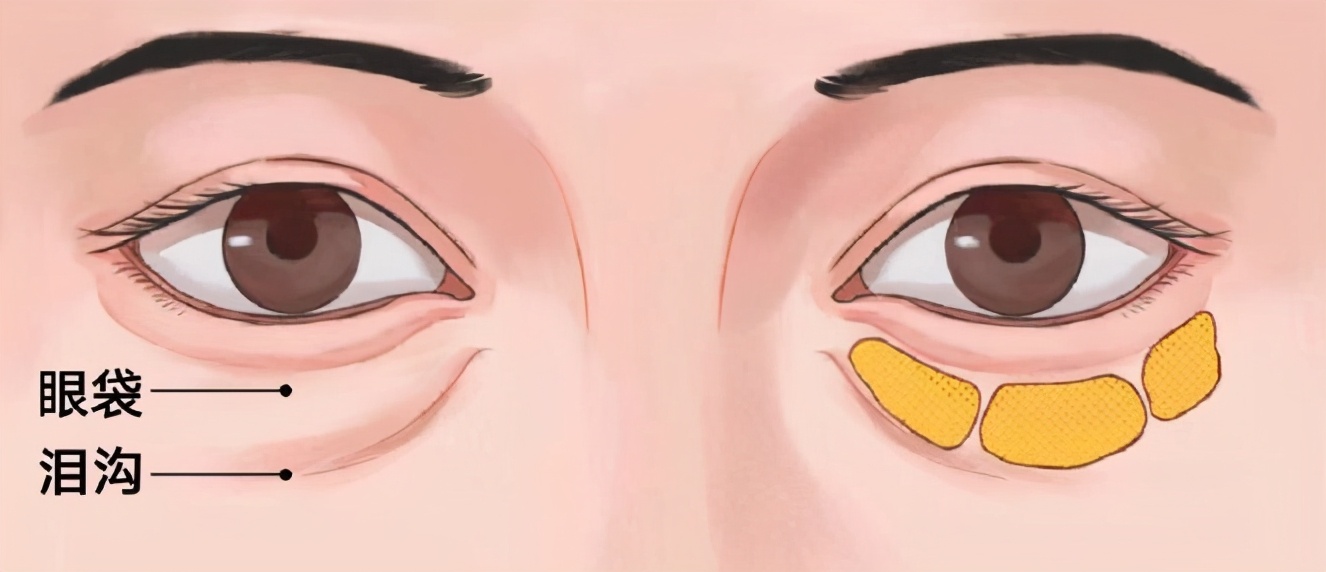 眼袋泪沟黑眼圈整形,24岁眼袋泪沟怎样去除最彻底