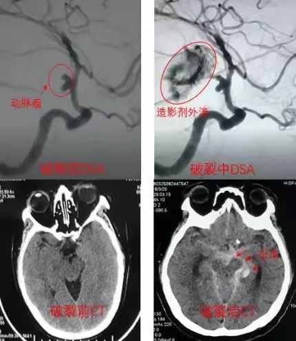 动脉瘤破裂时有什么症状,颅内动脉瘤有什么症状和表现