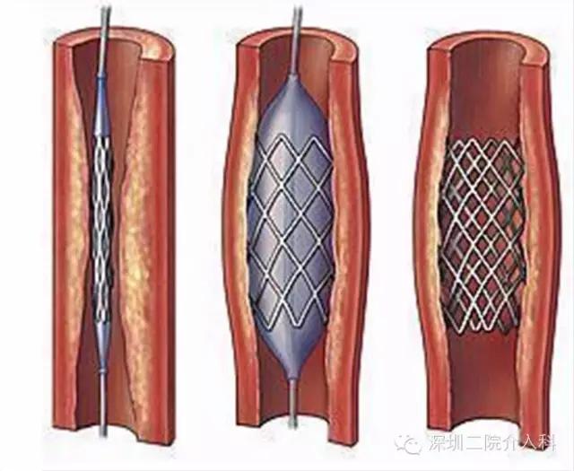 糖尿病下肢血管病变介入治疗,糖尿病足血管介入