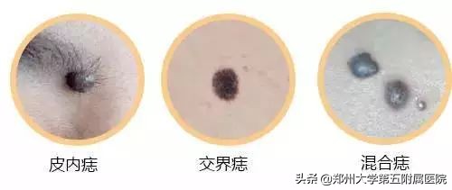 色素痣病理报告,头上色素痣图片