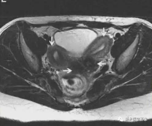 常见的几种子宫畸形诊断标准,先天性子宫畸形是什么原因造成的
