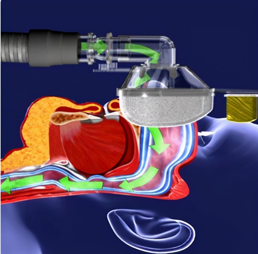 睡眠呼吸机使用指征,睡眠呼吸机的正确使用方法