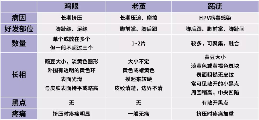 脚底长鸡眼一招搞定,脚底长鸡眼怎么治好了又复发