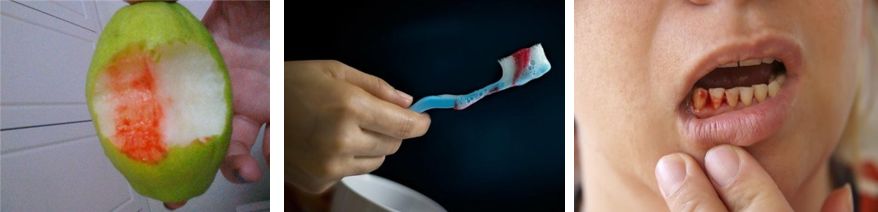 牙龈总是出血吃点什么药最好,牙龈总是一吸或者一舔就出血