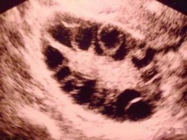 月经后错、多毛、长痘、肥胖，警惕多囊卵巢综合征