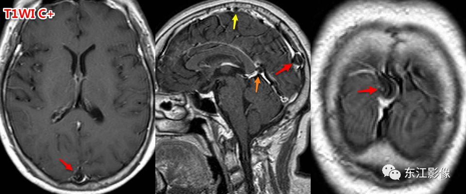 头颅mri扫描影像哪里找,头颅影像mra详细解说