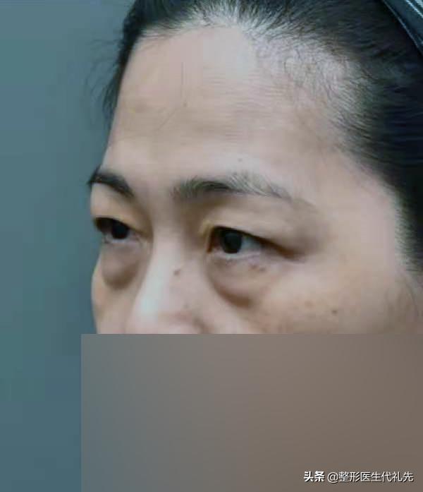 眼袋遗传的原因,眼袋大最简单手术去眼袋的方法