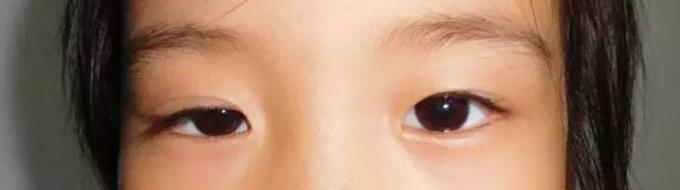 小儿推拿治疗上眼睑下垂,儿童推拿眼睛的正确方法