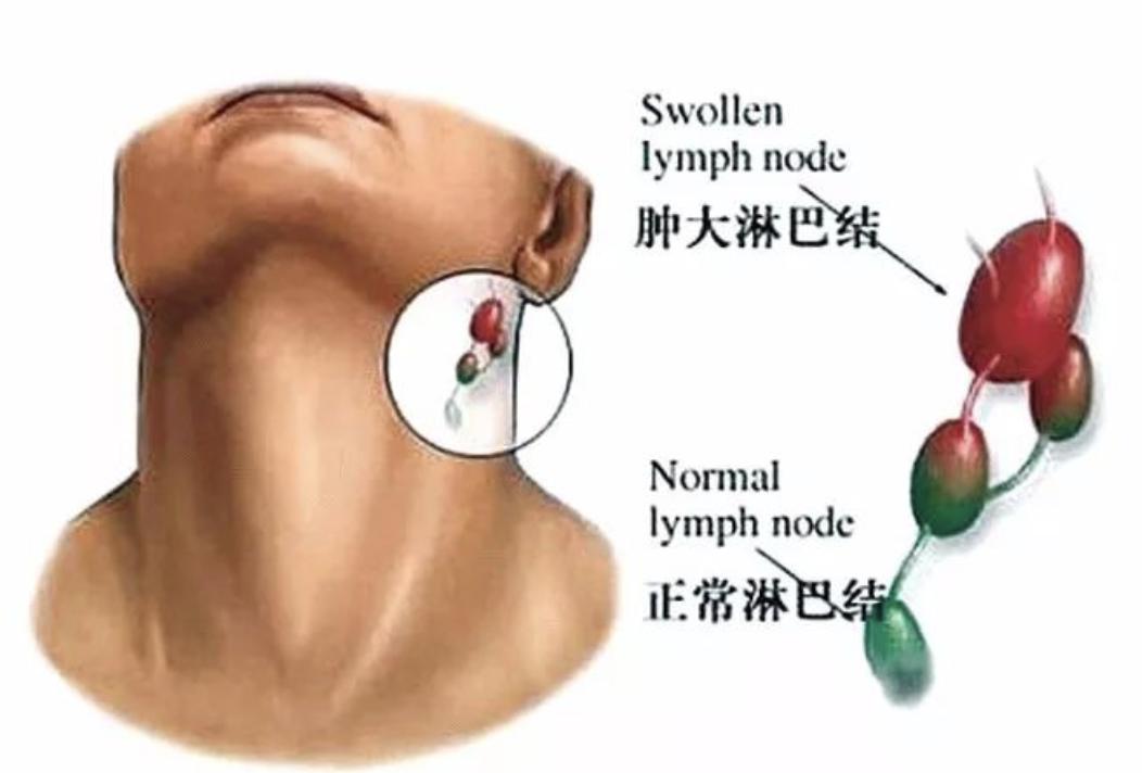 颌下淋巴结肿大预示什么,肺结核为什么引起淋巴结肿大