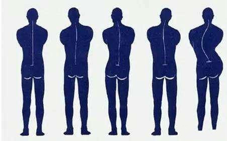 腰部脊椎疼是强直嘛,腰部强直是什么引起的