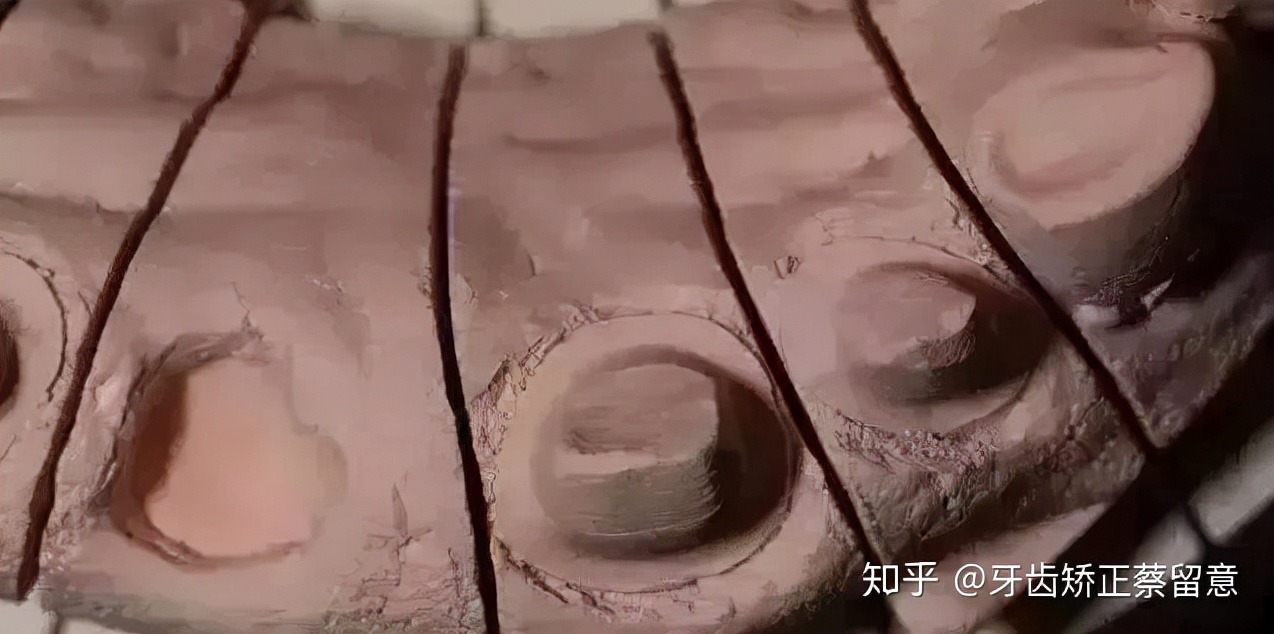 全瓷牙冠戴好了感觉咬合高了,戴了牙冠感觉大牙咬合不住