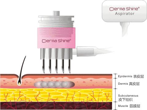 水光针真相大全,水光针一百多块钱是真的假的