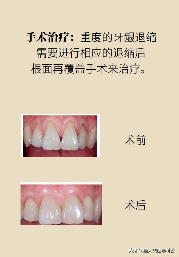 牙根露出来怎样修复不动刀,牙根暴露但没疼痛感怎么办