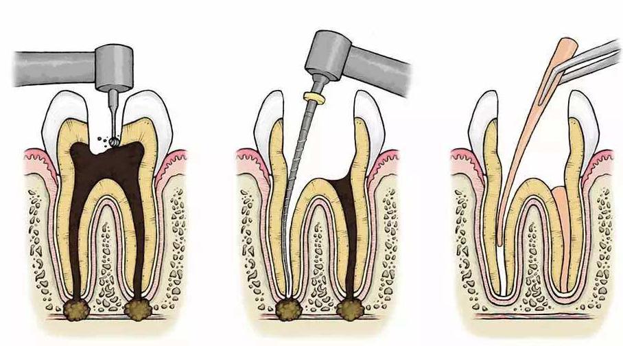 牙医使用的钻头型号,牙医的钻头都是什么作用