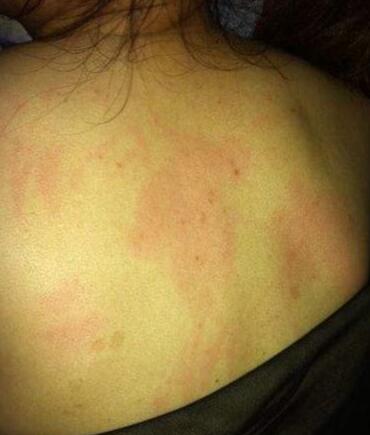 后背痘痘好了但是留有黑色印,后背很多痘痘和痘印怎么办