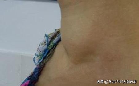 甲状腺结节血流信号怎么看,甲状腺结节报告怎么看