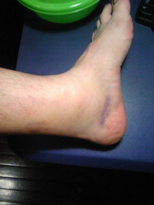 踝关节扭伤打绷带的图片,踝关节扭伤消肿治疗方法