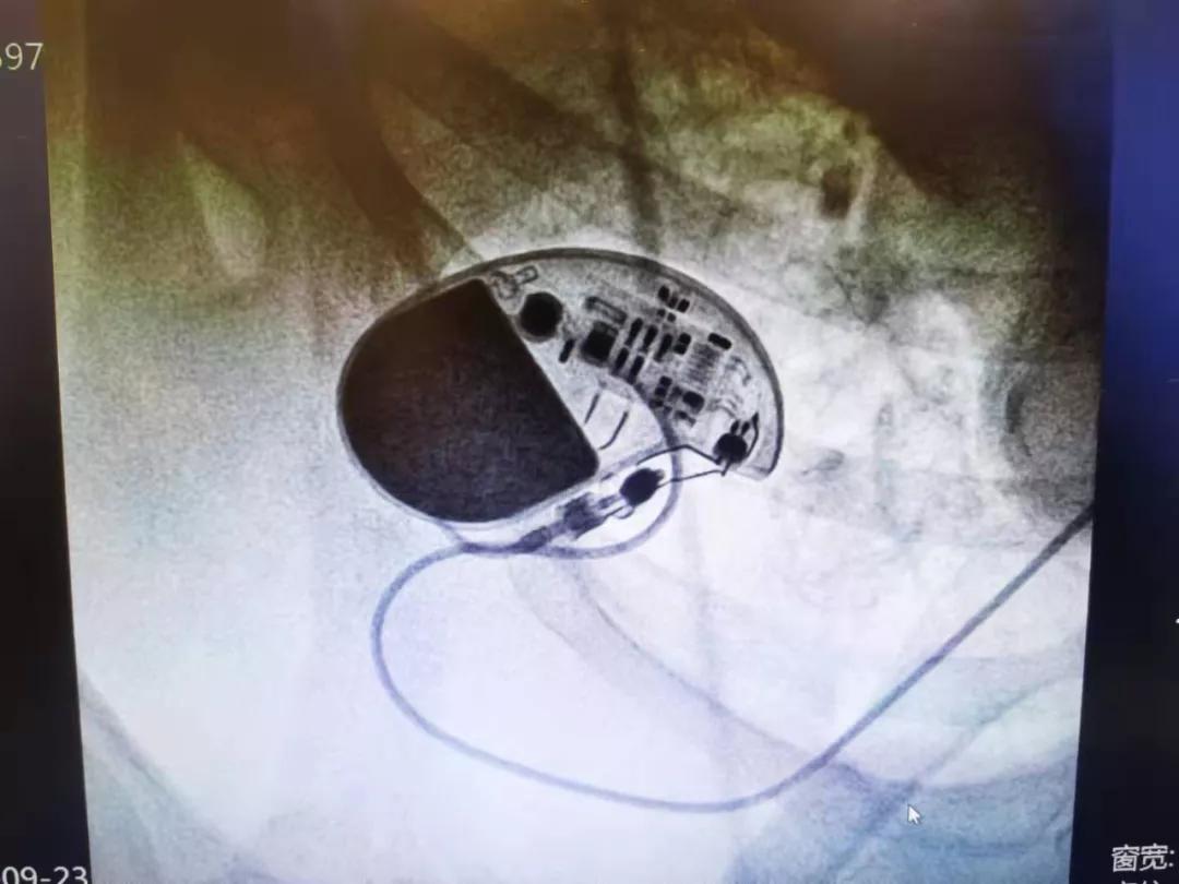 太原哪个医院做心脏起搏器好了,太原市心血管医院心脏起搏器