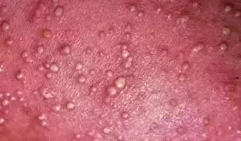 宝宝夏天起痱子需要抹药吗,婴儿夏天起痱子最有效的解决方法