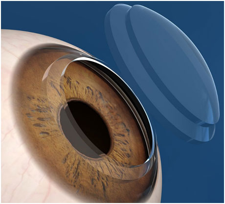 眼角膜受损怕光怎么办,眼角膜什么情况下会受损