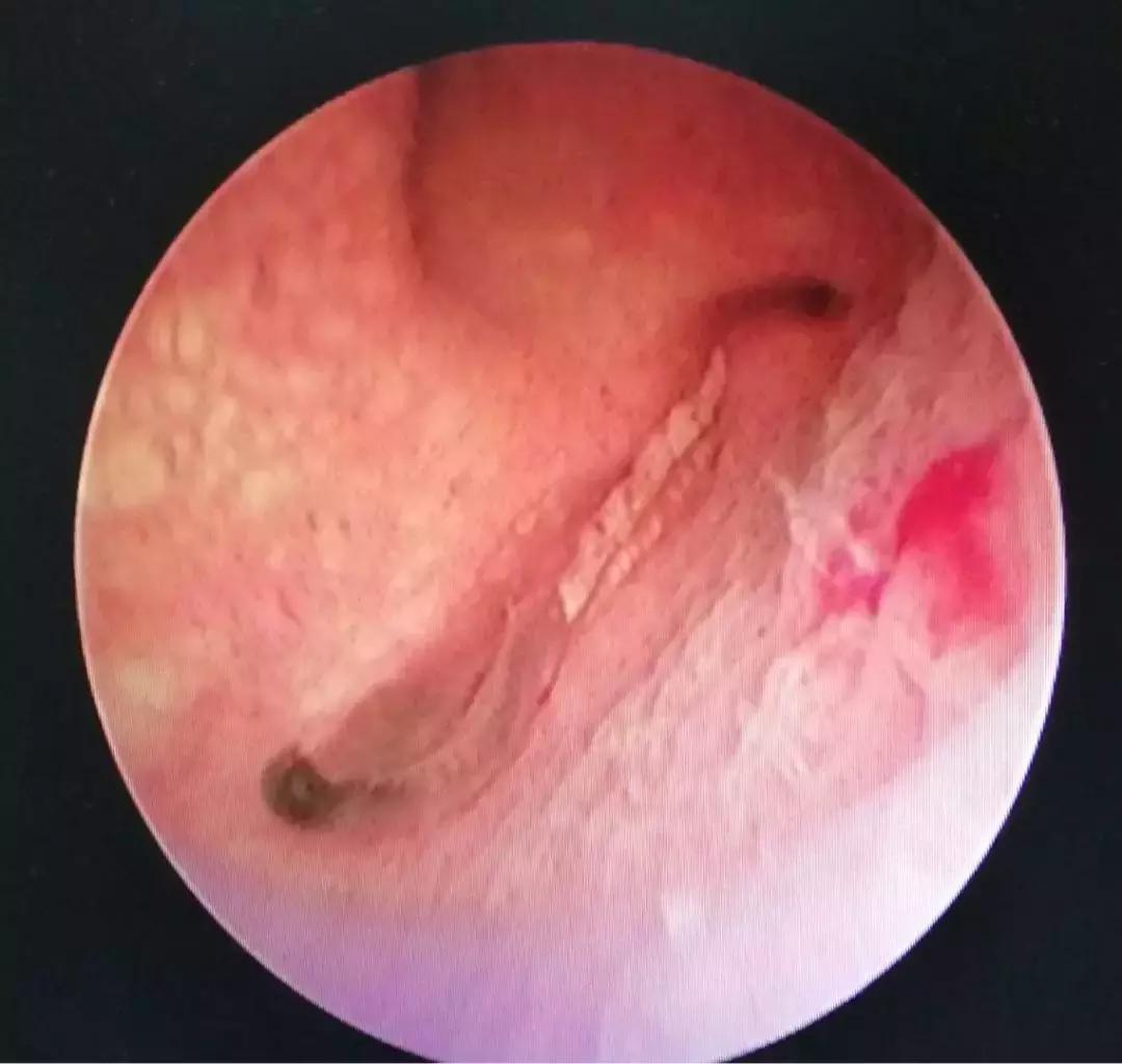 医生从人身上取出白色虫子,女子体内取出活虫只因爱吃这样菜