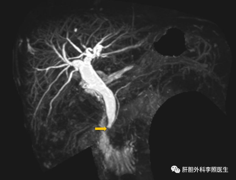 胆囊切除30天就疼,胆囊结石切除后半年疼痛什么原因