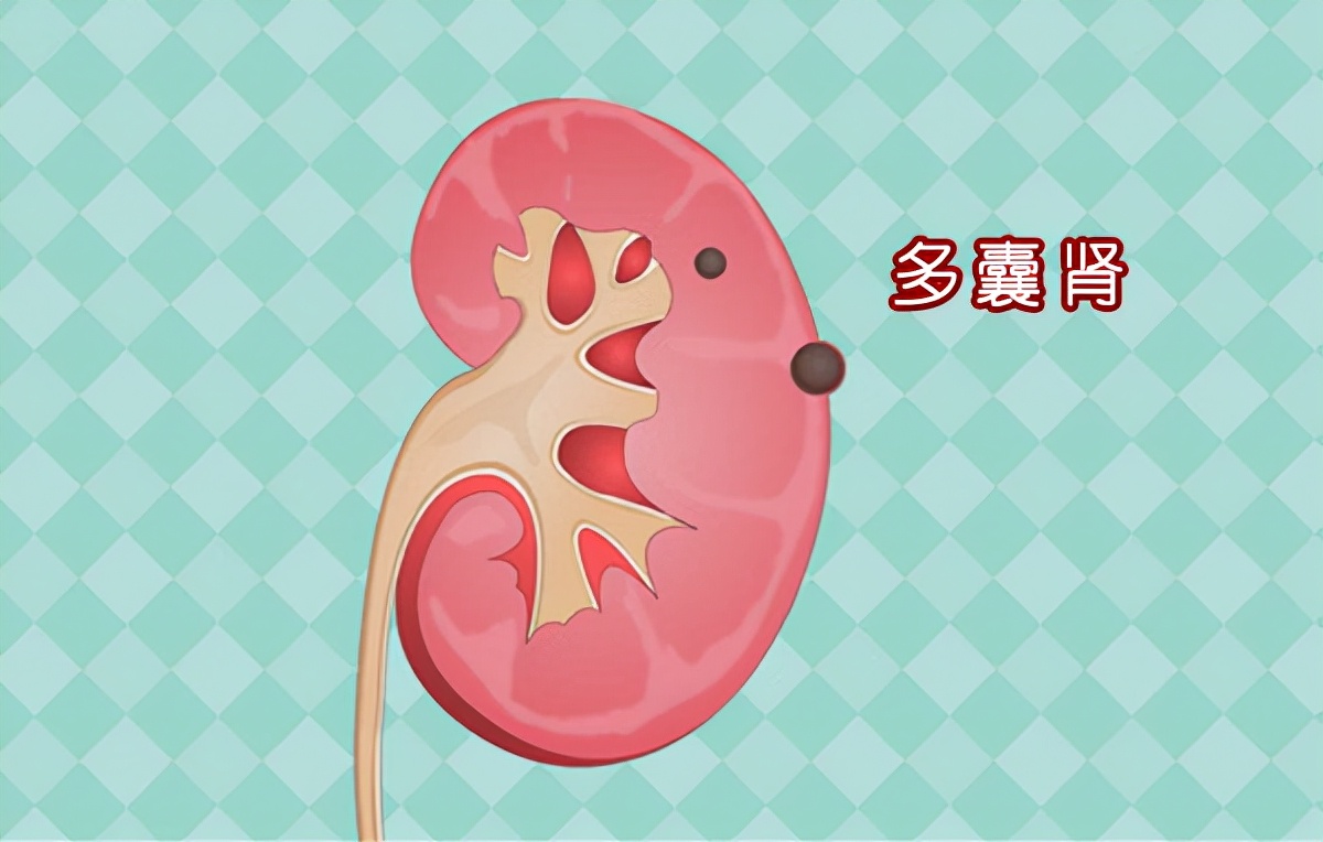 男性多囊肾怎么治疗比较好呢,70岁老人多囊肾怎么治疗