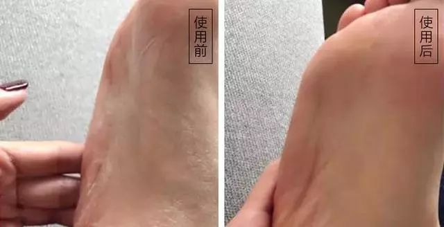 冬天手脚裂口,手脚冬天裂口怎么治疗