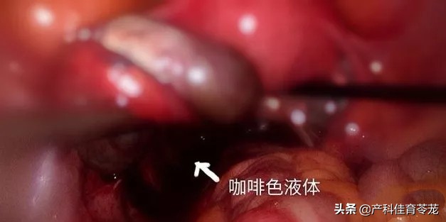 小姑娘痛经，也可能是大问题