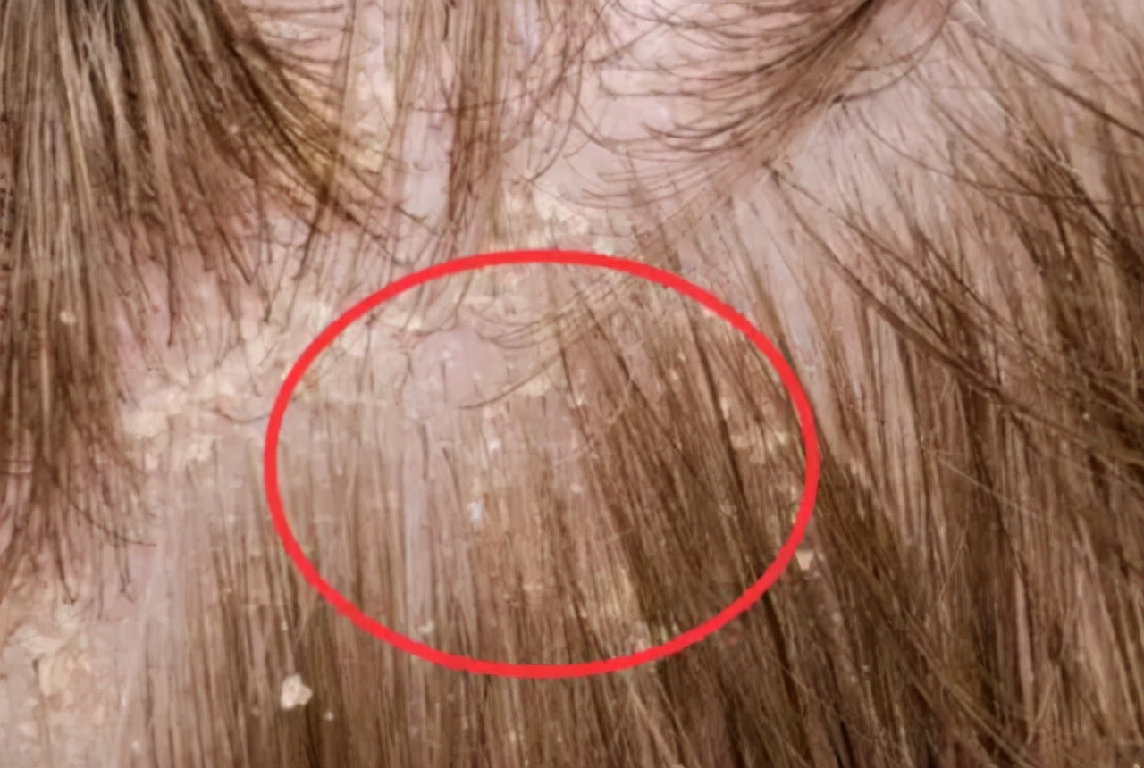 头皮和脸上起疙瘩有脓包怎么回事,头皮上总出油长有疙瘩或脓包