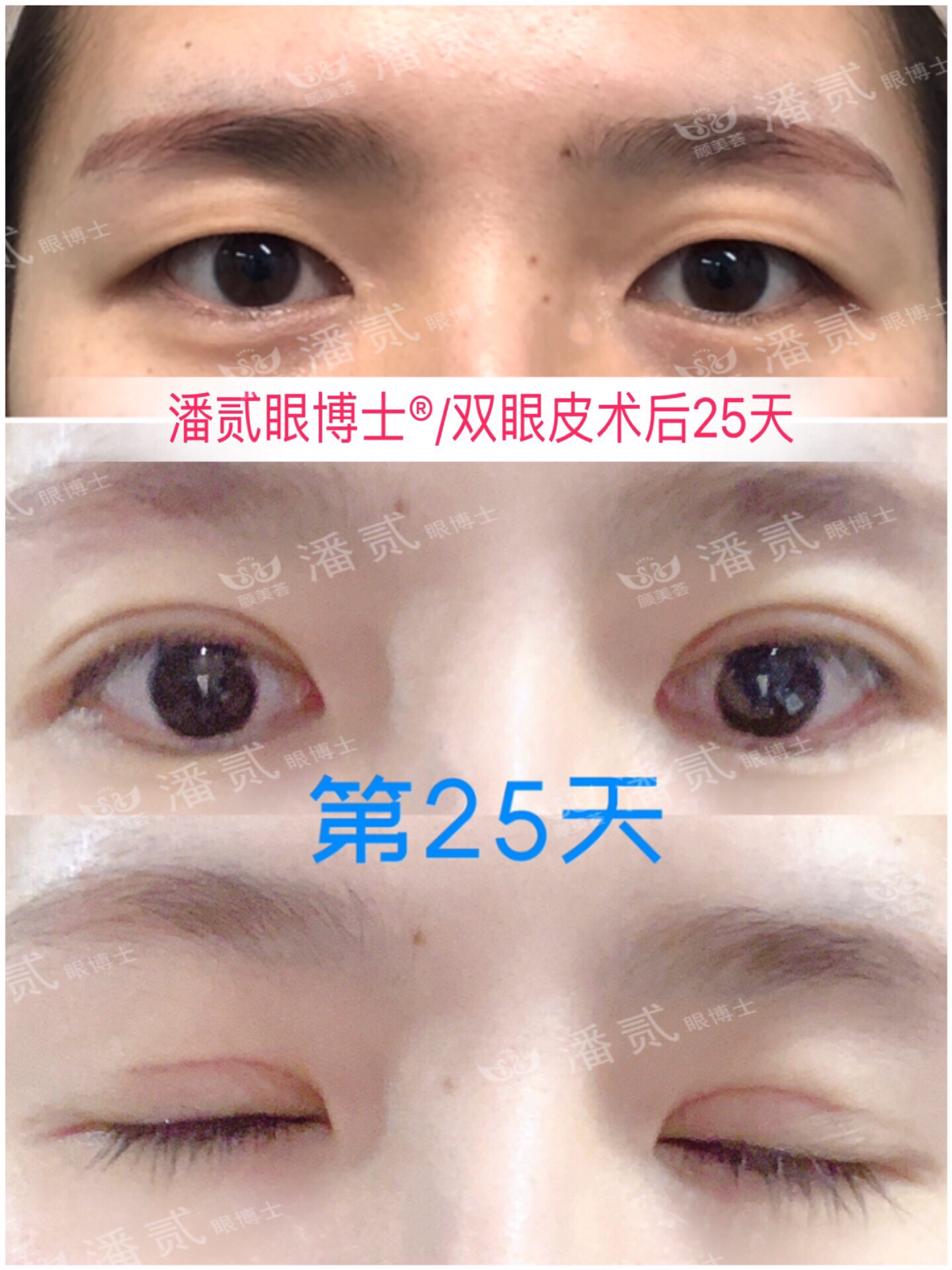 双眼皮眼尾割长了而且上扬怎么办,眼睛眼尾下垂做什么样双眼皮