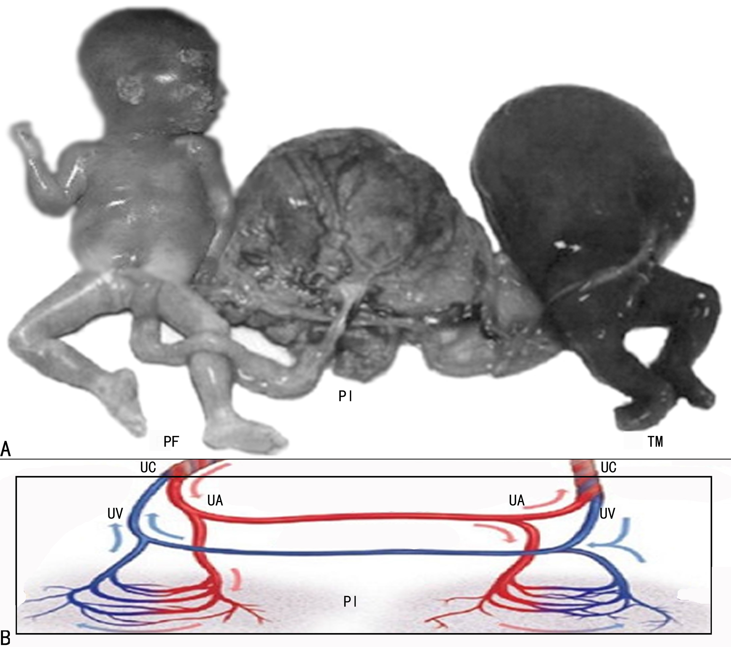 多胎妊娠超声早期图像,2个月怀孕彩色超声诊断报告单