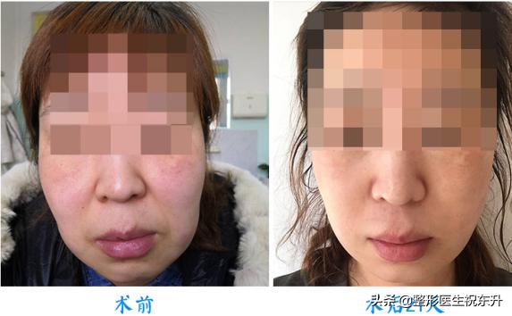 双下巴、脖子粗,又丑又显老,如何减掉双下巴?