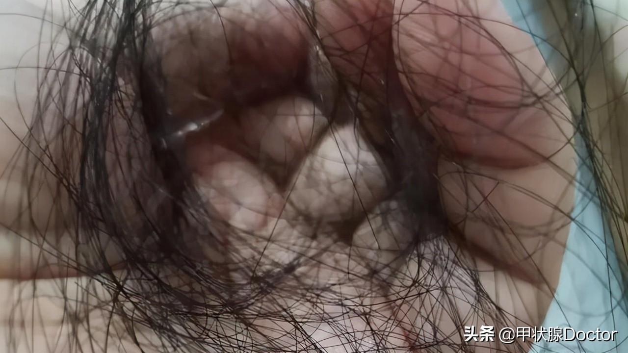 吃一辈子优甲乐会有什么副作用,终身吃优甲乐出现了副作用怎么办