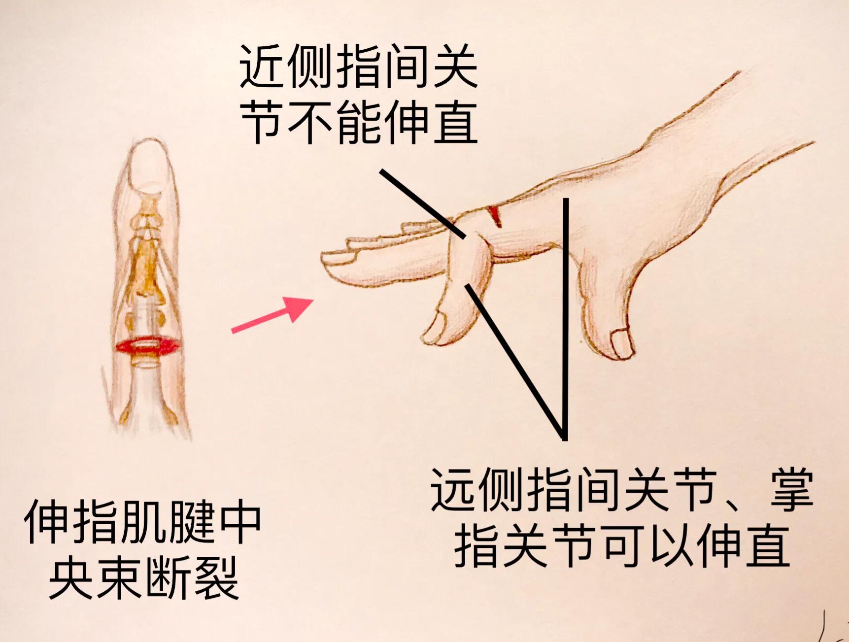 手被割伤如何处理,手被割伤了较深要如何处理