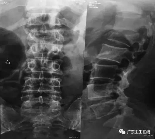 高空坠落腰椎骨折保守治疗方法,高处跌落腰椎骨折手术后多久恢复