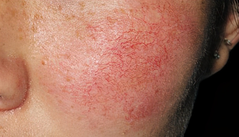 脸部红血丝多怎么消除,脸部红血丝怎么消除小妙招