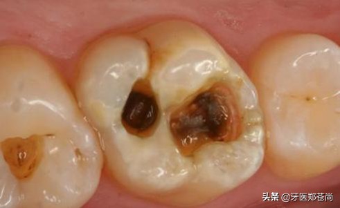 蛀牙很深但是不痛需要根管治疗吗,蛀牙根管治疗是什么样的