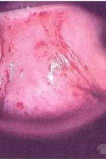 60岁外阴痒腥臭味是哪种炎症,五十岁外阴瘙痒分泌物呈深褐色